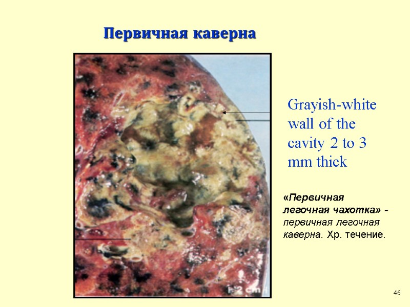 Первичная каверна Grayish-white wall of the cavity 2 to 3 mm thick  46